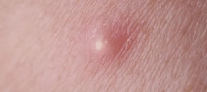 Pryszcze w miejscach intymnych - co je powoduje i kiedy się martwić