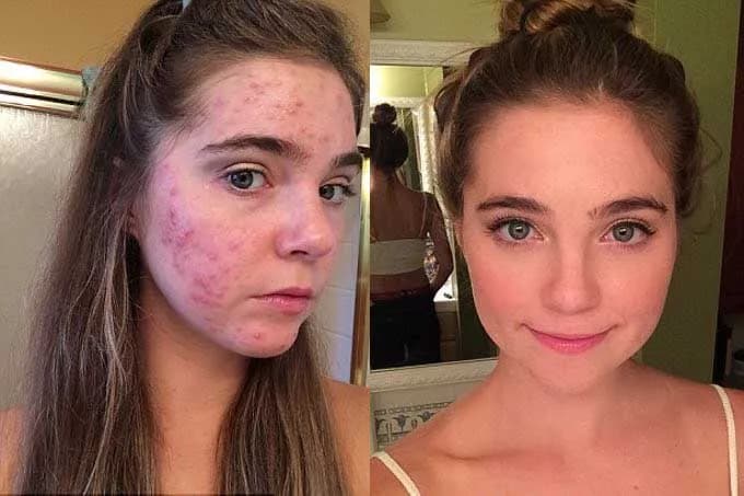 Jak pozbyć się pryszcza, który jeszcze nie wyszedł – skuteczne metody