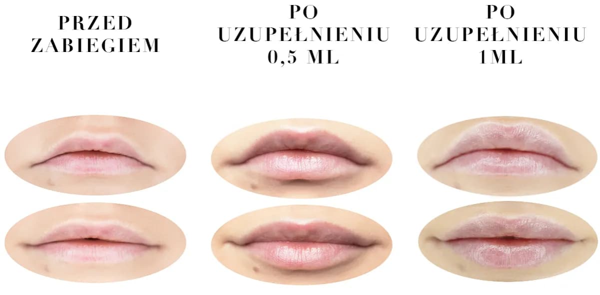 Czy można się całować po powiększaniu ust? Oto co musisz wiedzieć