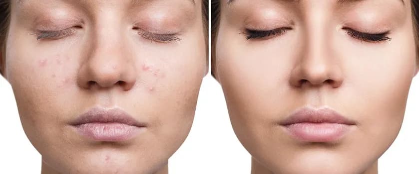 Skuteczne sposoby na wybielenie czerwonych plam po pryszczach