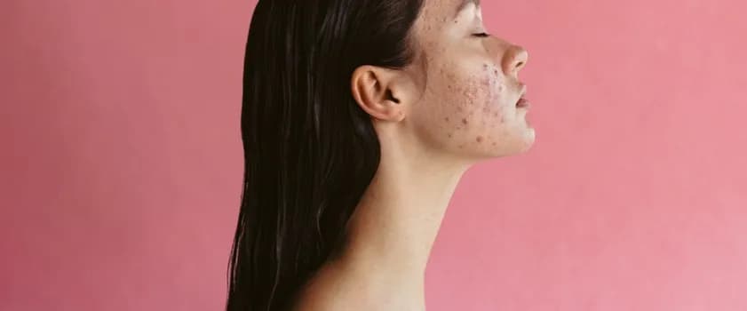 Jak szybko zagoić ranę po pryszczu - skuteczne metody na blizny