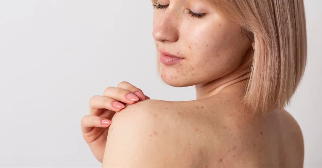 Jak pozbyć się śladów po pryszczach – skuteczne metody i porady