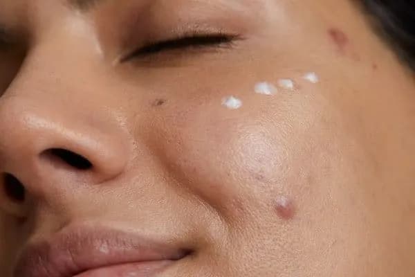 Pryszcze od czego? Odkryj ukryte przyczyny i skuteczne rozwiązania