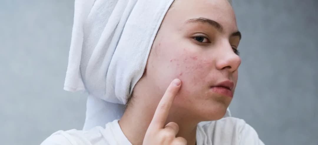 Skuteczne sposoby na bolący pryszcz – jak szybko złagodzić ból